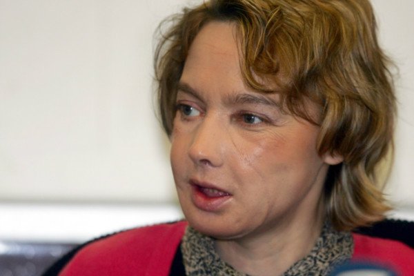 trasplante de rostro