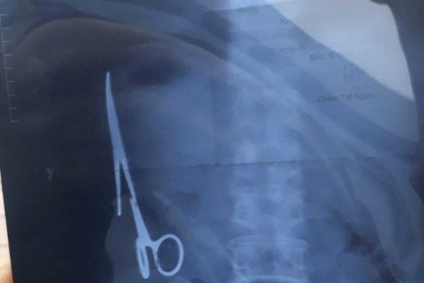 tijeras alojadas durante 18 años